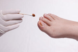 Šta kad imate urasli nokat: Prijeti infekcija ako ne sanirate...