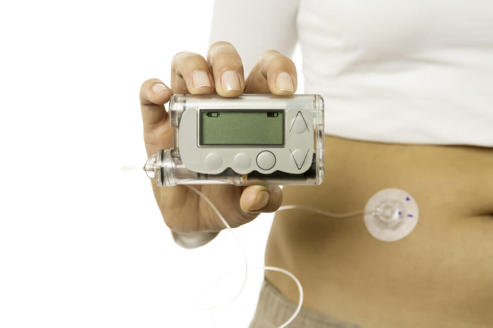 Insulinska pumpica (ilustracija), Foto: Shutterstock