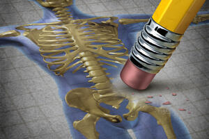 Krhke kosti: Ovim povećavate šanse za nastanak osteoporoze