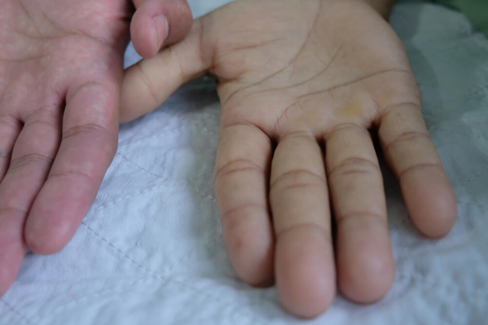 Poređenje ruke osobe koja ima anemiju i one koja nema, Foto: Shutterstock