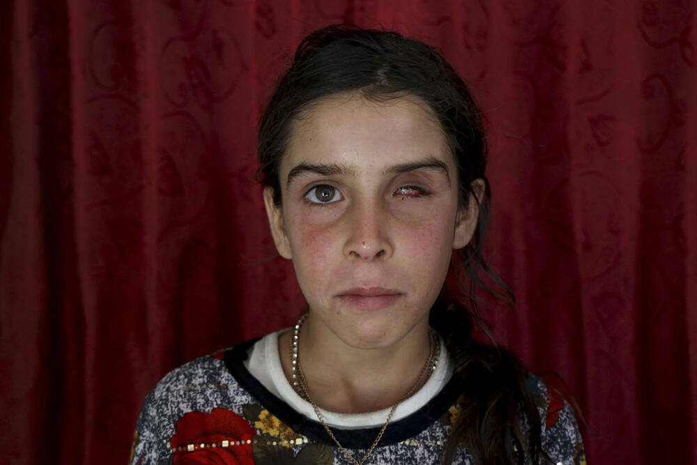 Sirijka Rava al Hasan (12) je izgubila oko od kasetne bombe