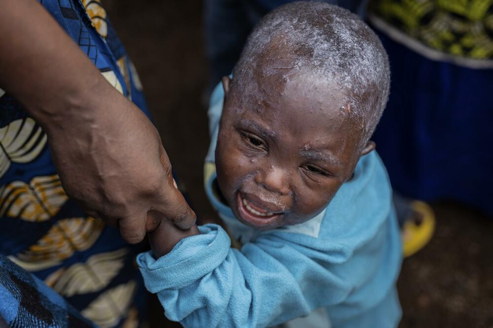 Epidemija u Kongu počela širenjem endemskog soja, Foto: Beta/AP