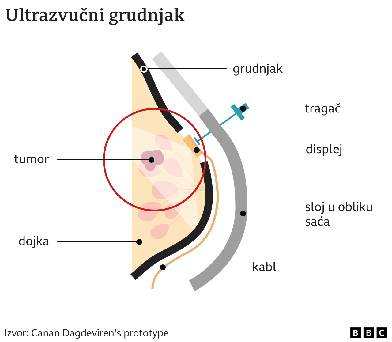 Ultrasound bra - a new invention for early detection of breast cancer